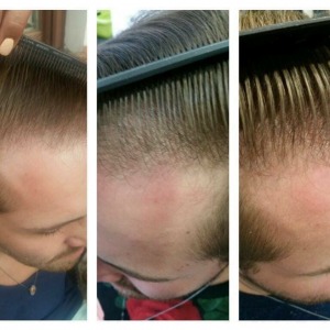 Anti-Haarausfall Therapie