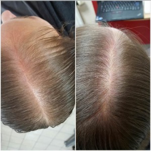 Anti-Haarausfall Therapie
