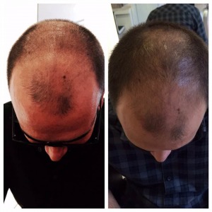 Anti-Haarausfall Therapie