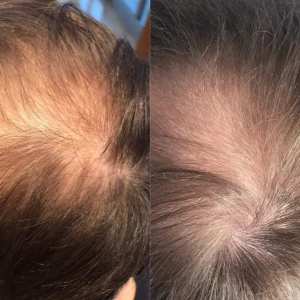 Antihaarausfall Ttherapie