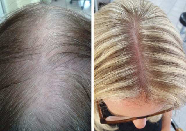 Anti-Haarausfall-Therapie